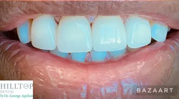 Hilltop Dental by Dr. George Apelian