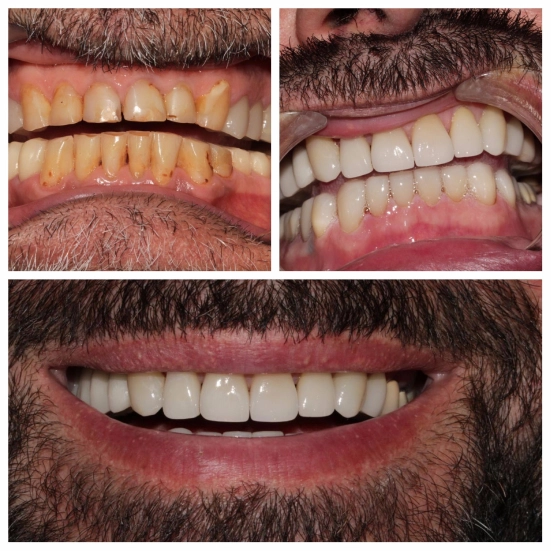 before-after before-after